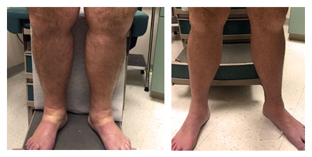 treatment dvt thrombosis deep vein before after left radiology month right